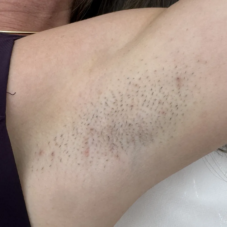Close crop of an underarm photographed in the clinic before the sessions.