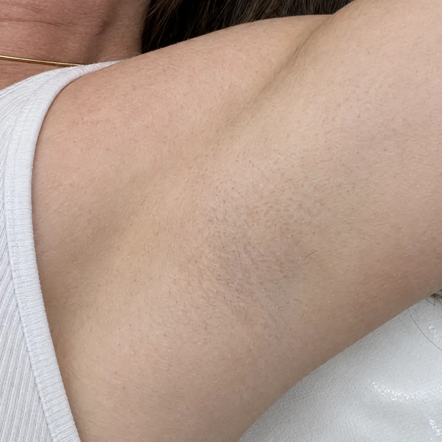 The same underarm, at the same angle and distance, photographed after the sessions.