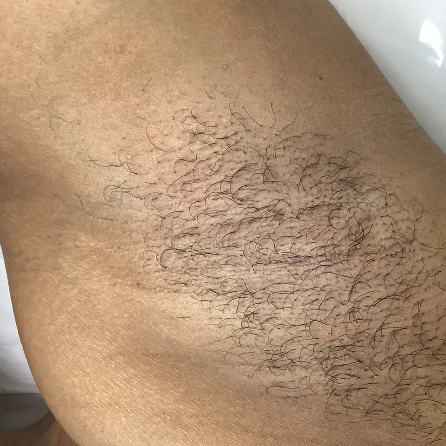 Close crop of a second client’s underarm, photographed in the clinic before the sessions.