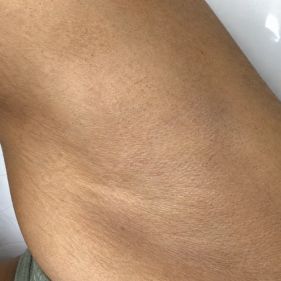 The same underarm, at the same angle and distance, photographed after the sessions.